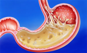 stomach-acid-reflux