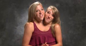 conjoined-twins-abby-and-brittany-today-1642777922068